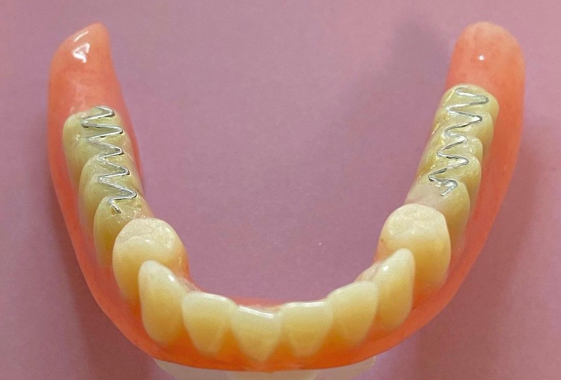 Replacing 40 Year Old Dentures Before & After Photos Fort Lauderdale FL