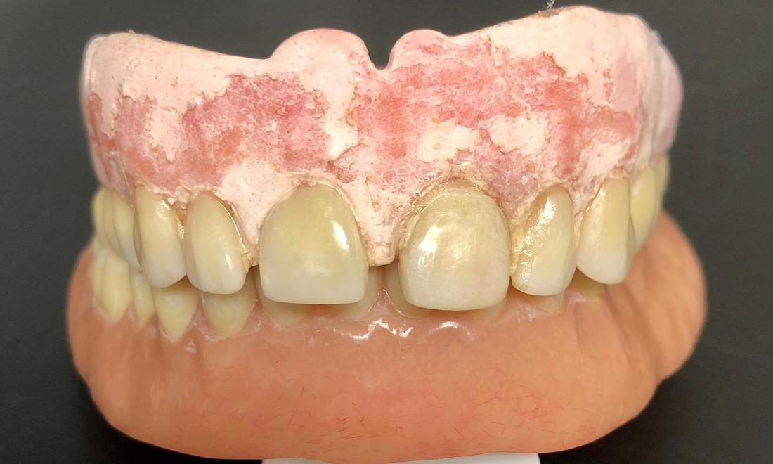 Copy and Spare Duplicate Dentures Before & After Photos Fort Lauderdale FL